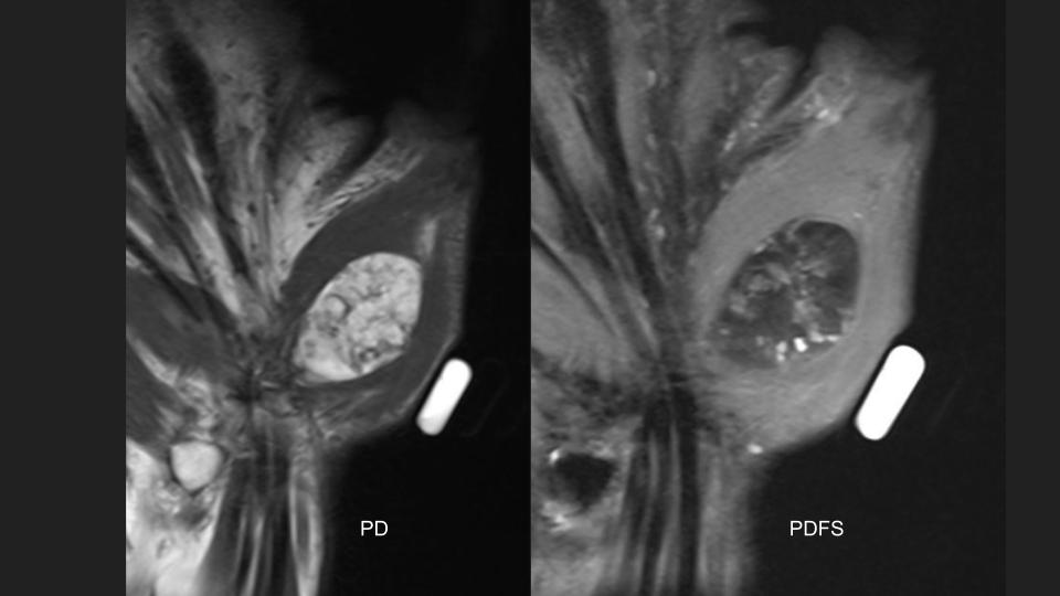 Figure 3 for case chondroma ( RID4126 )